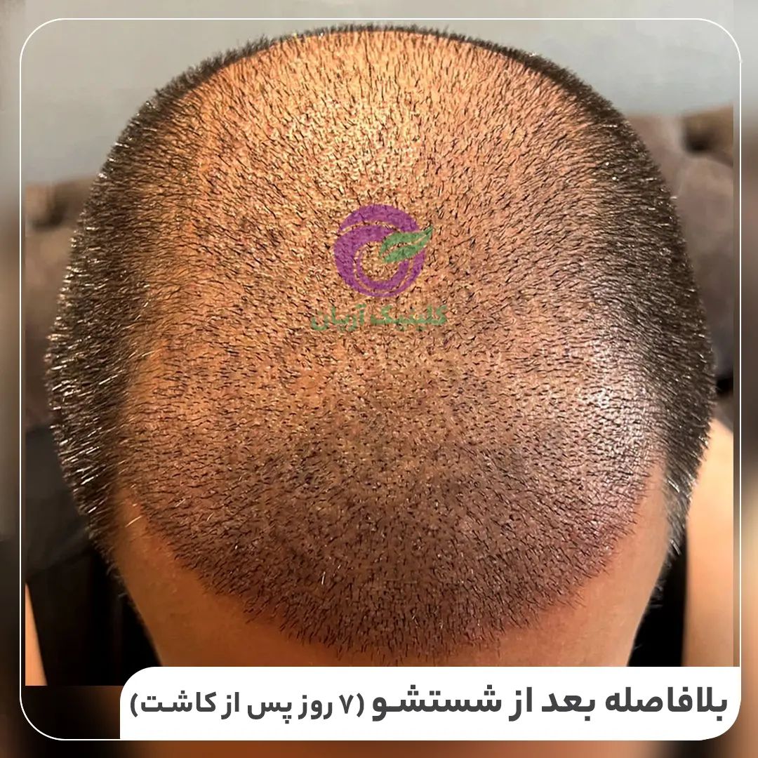 گالری کاشت مو 